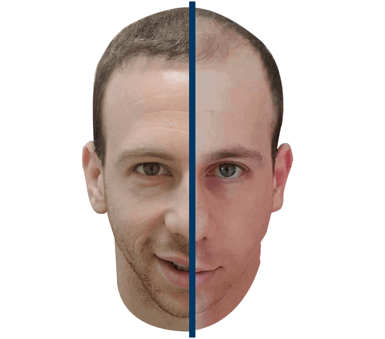 לפני ואחרי ניתוח השתלת שיער